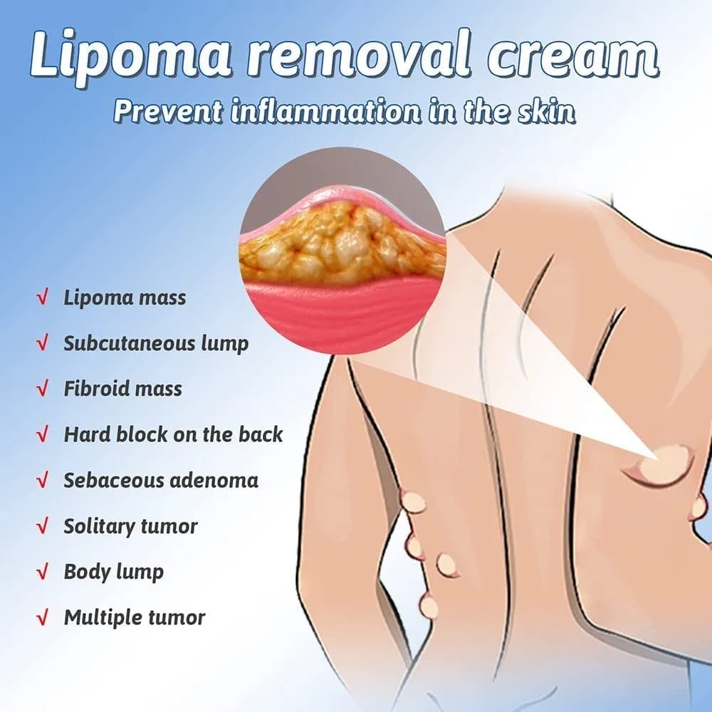Herbal Lipoma Removal Cream & Spray | Non-Surgical Lump & Fat Knot Relief Ointment